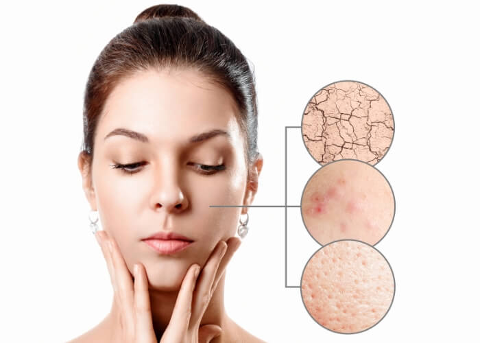 young woman with acne dry skin black dots skin