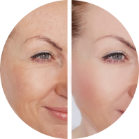 A comparison image showing a woman's wrinkles before and after treatment, revealing a noticeable improvement in her skin's appearance.